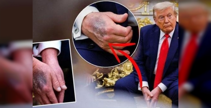 Trump, elindeki morlukların nedenini açıkladı: 'Aspirin kullanıyorum
